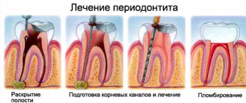 Скопление гнойного экссудата вокруг корня зуба приведет к ощущению, что зуб как бы вырос и стал длиннее других, да еще и двигается