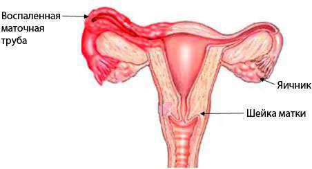 Воспаление маточных труб: симптомы, причины, это