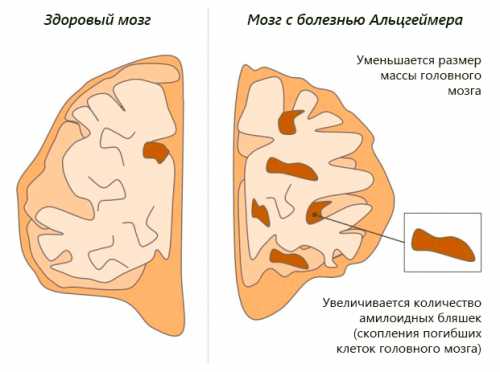 Предполагается, что существует генетическая предрасположенность к данному заболеванию выделен так называемый ген семейной формы, в случае мутации которого и развивается болезнь