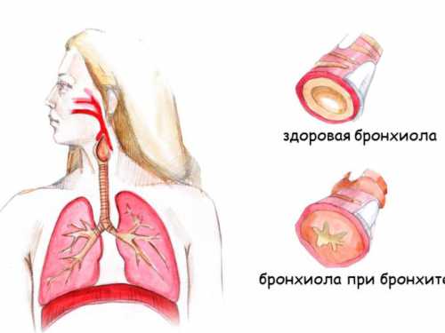 Лечение трахеита в домашних условиях